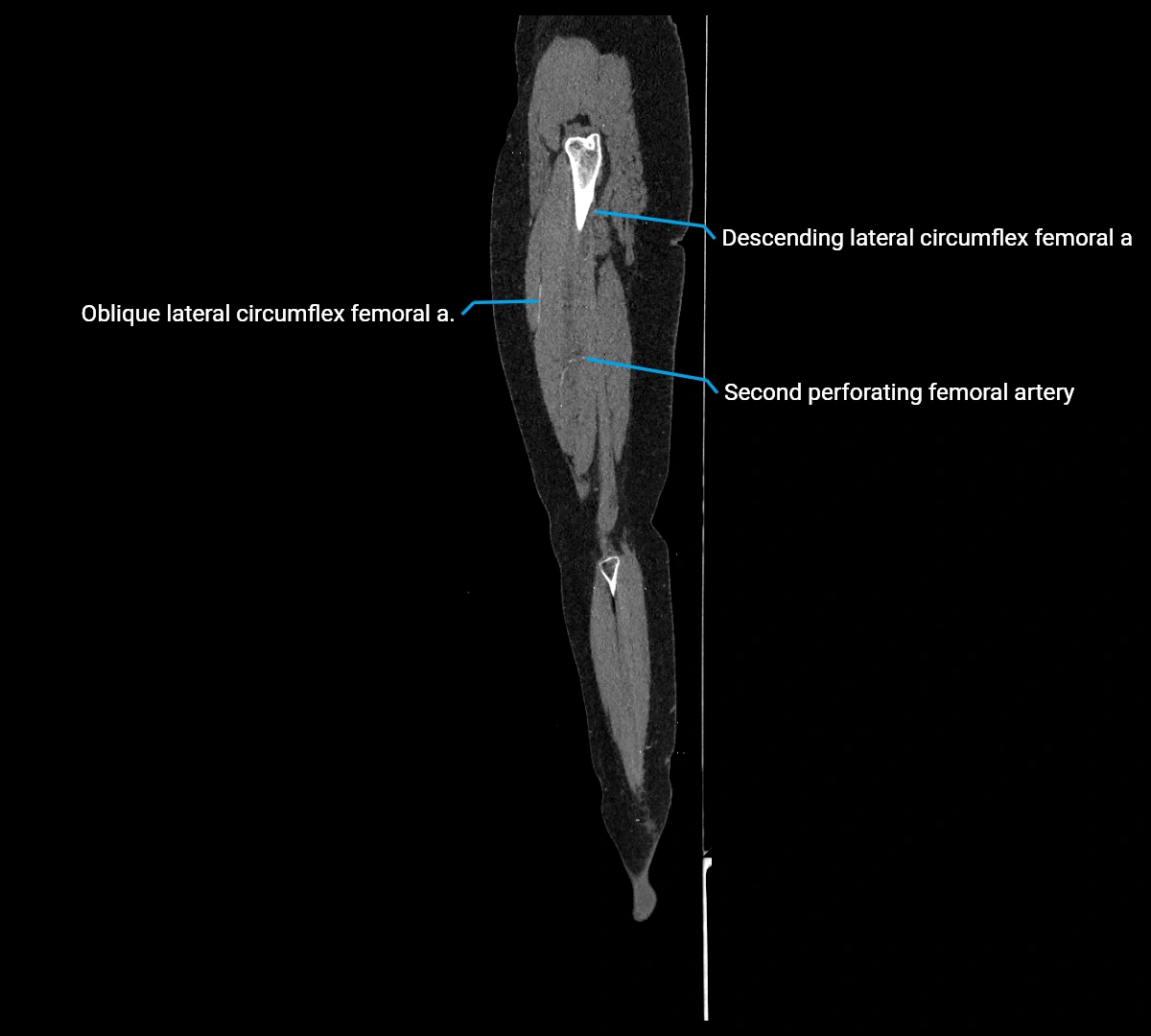 CTA lower limb sagittal cross sectional anatomy labelled image _62 (3).webp